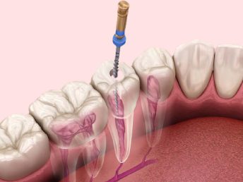 Root Canal Treatment